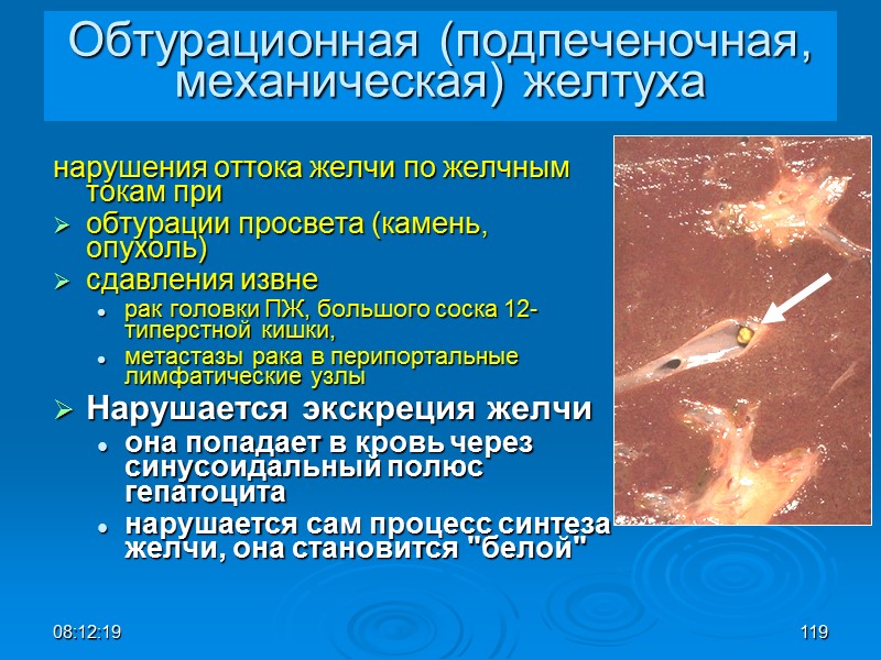 08:12:02 119 Обтурационная (подпеченочная, механическая) желтуха нарушения оттока желчи по желчным токам при 